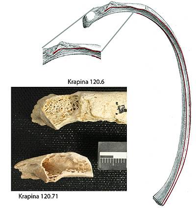 bone tumor